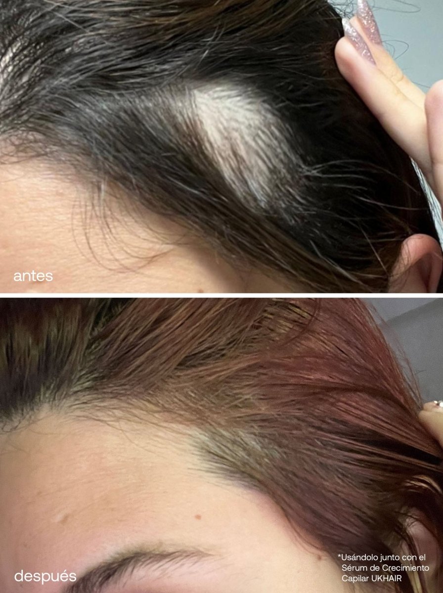 Advanced Scalp Dermaroller - UKLASH España