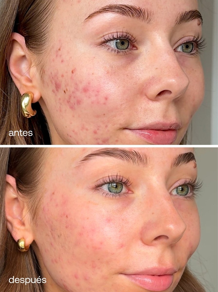 Máscara Facial LED Dual Light Pro-Therapy - UKLASH España